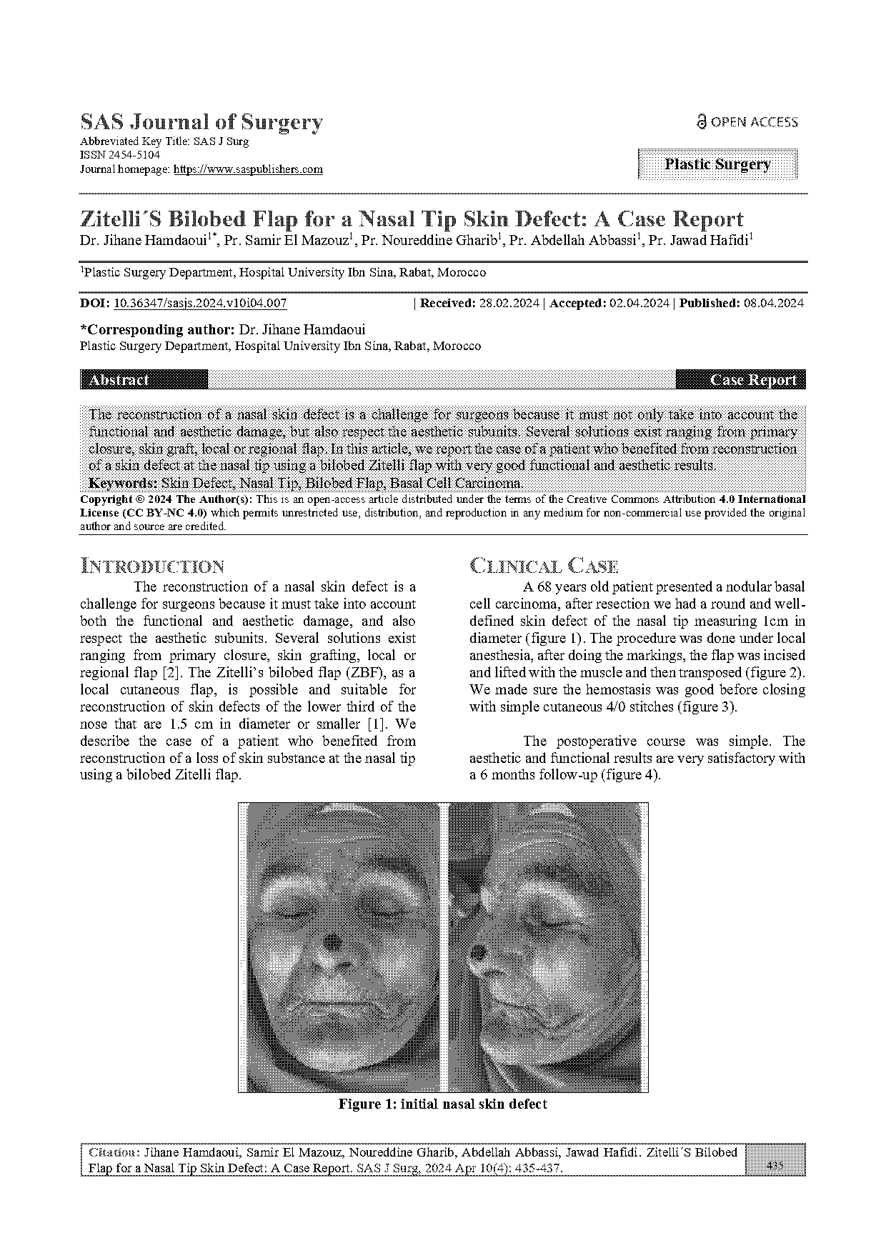 zitelli modification of bilobed flap