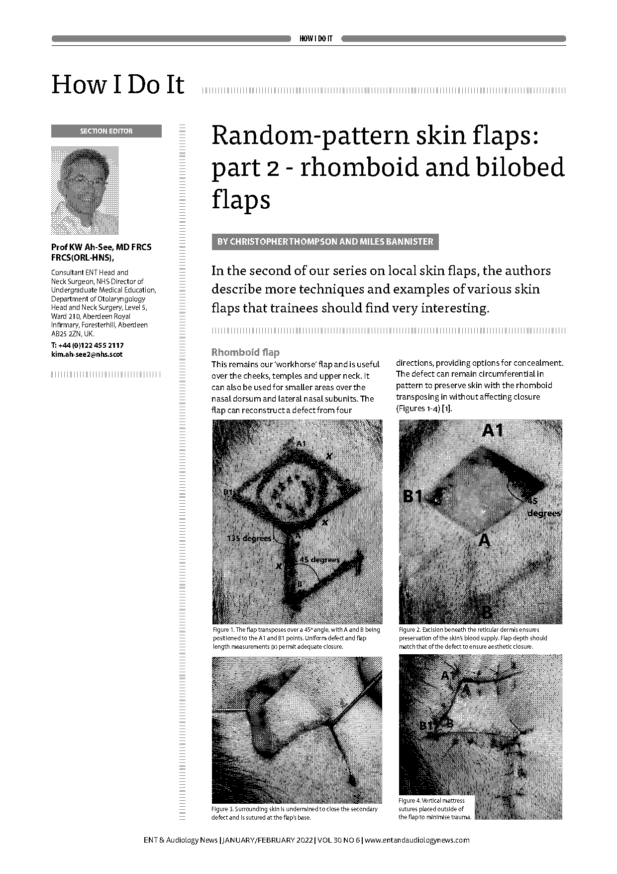 zitelli modification of bilobed flap